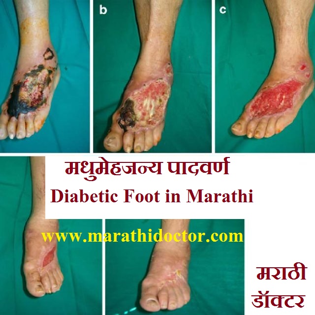 मधुमेहजन्य पादवर्ण, डायबेटीक फुट ची सर्व माहिती, Diabetic Foot in Marathi, मधुमेहजन्य पाद व्रण होण्याची कारणे, लक्षणे, प्रतिबंध, उपचार