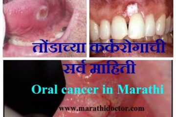 symptoms of mouth cancer in marathi, what are the first signs of mouth cancer, oral cancer in marathi, oral cancer symptoms in marathi, तोंडाच्या कर्करोगाची सर्व माहिती, तोंडाच्या कर्करोगाची लक्षणे, symptoms of mouth cancer in marathi, signs of mouth cancer, oral cancer symptoms in marathi
