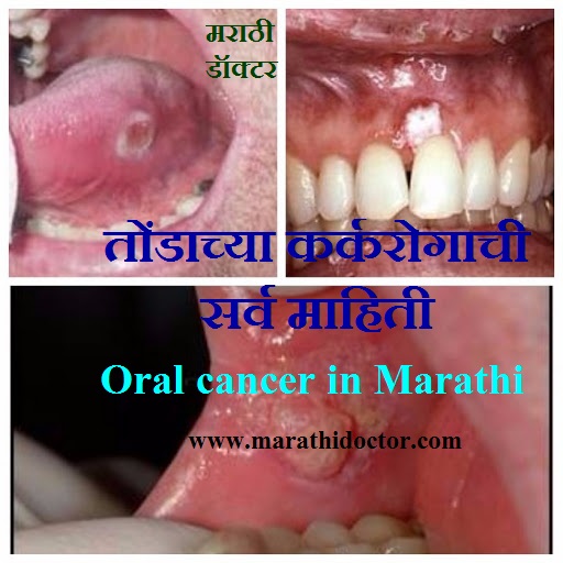symptoms of mouth cancer in marathi,