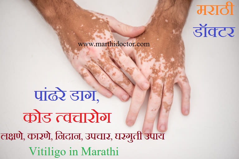 पांढरे डाग, कोड त्वचारोग Vitiligo in Marathi
