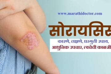 सोरायसिस कारणे, सोरायसिस लक्षणे, सोरायसिस घरगुती उपाय, सोरायसिस उपचार, सोरायसिस आधुनिक उपचार, सोरायसिस त्वचेची काळजी, सोरायसिस बायोलॉजिक्स, Psoriasis Cause in marathi, Psoriasis symptoms in marathi, Psoriasis Treatment in marathi,